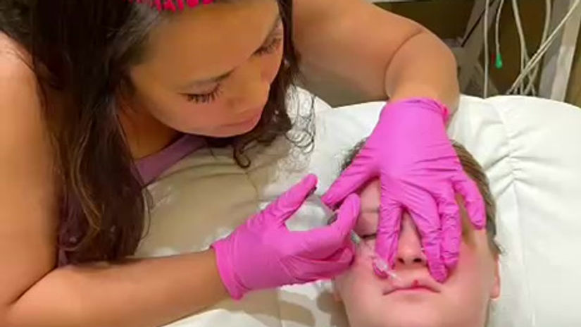 LIP FILLER